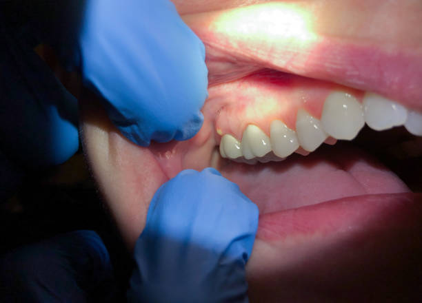 Best Knocked-Out Tooth Emergency  in Kiawah Island, SC